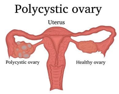 PCOS Doctor New York City